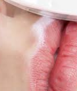 TRIỆT LÔNG MÉP