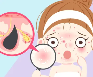 MỤN Ở ĐỘ TUỔI DẬY THÌ – NGUYÊN NHÂN VÀ PHƯƠNG PHÁP ĐIỀU TRỊ CHUẨN Y KHOA