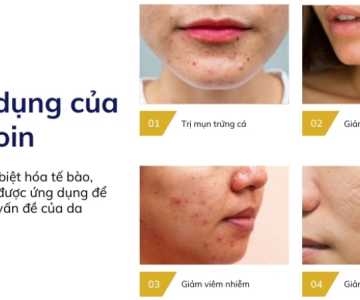 TRỊ MỤN NÊN DÙNG TRETINOIN HAY ADAPALENE?