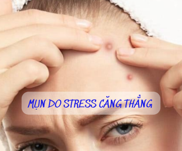 MỤN DO STRESS - CÁCH ĐIỀU TRỊ VÀ KIỂM SOÁT CĂNG THẲNG