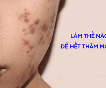 THÂM MỤN LÀ GÌ ? CÁCH ĐIỀU TRỊ THÂM MỤN HIỆU QUẢ