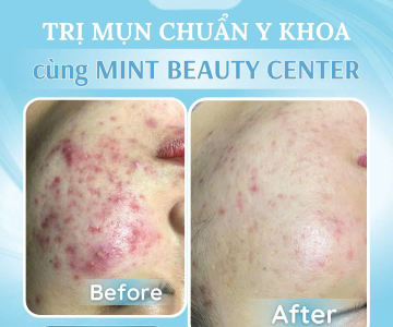  ĐÁNH GIÁ 5 SPA TRỊ MỤN VÀ LÀM ĐẸP UY TÍN Ở TP THỦ DẦU MỘT - BÌNH DƯƠNG 
